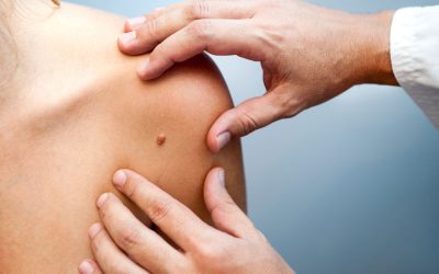 Mohs Surgery: A Guide to Precision Skin Cancer Treatment…