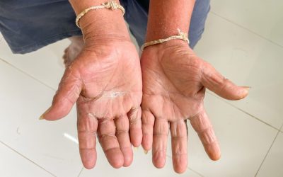 What is Scleroderma? A Guide For Scleroderma Symptoms, Types, and Treatment in Northern Kentucky…