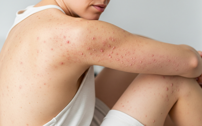 Eczema: Symptoms, Diagnosis, and Treatment…