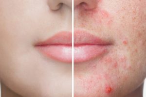 Split-face image: left side clear skin, right side red, inflamed acne with pimples showing before/after comparison.
