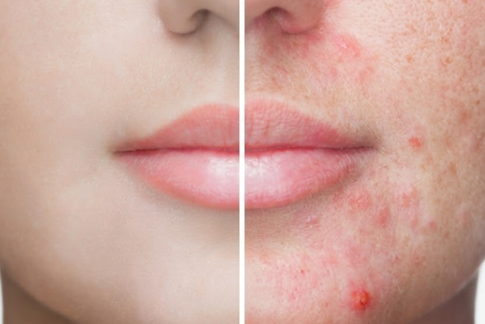 Split-face image: left side clear skin, right side red, inflamed acne with pimples showing before/after comparison.