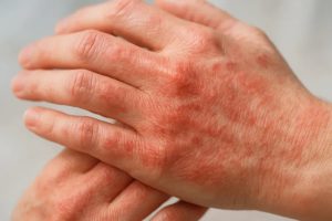 Close-up of reddened, irritated hands with dry, scaly patches, suggesting dermatitis or eczema relief in progress.