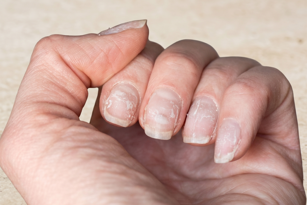 Close-up of a hand with peeling, dry nails and white flaky edges on several fingernails.