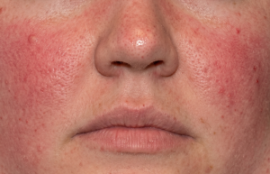 Close-up of a person's nose and cheeks showing red, inflamed skin with small red bumps (rosacea/acne).