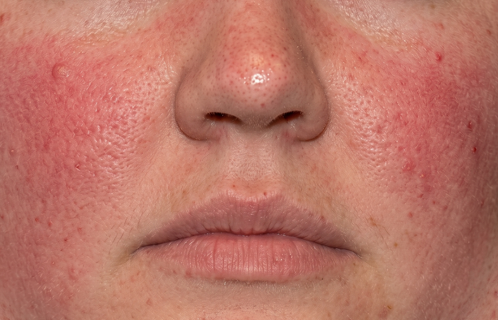 Close-up of a person's nose and cheeks showing red, inflamed skin with small red bumps (rosacea/acne).