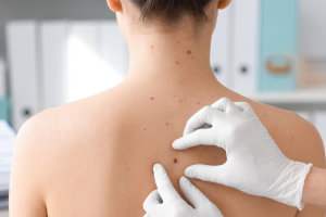 Dermatologist wearing gloves examines back moles on a patient.